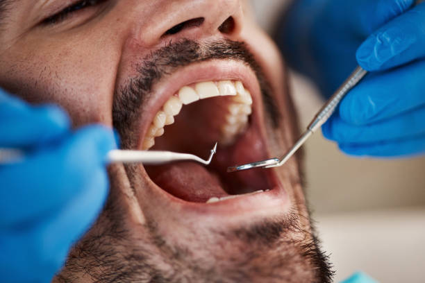 Best Chipped Tooth Repair Near Me  in Barnhart, MO